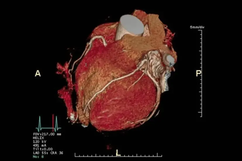Cardiac CT (Calcium Score)